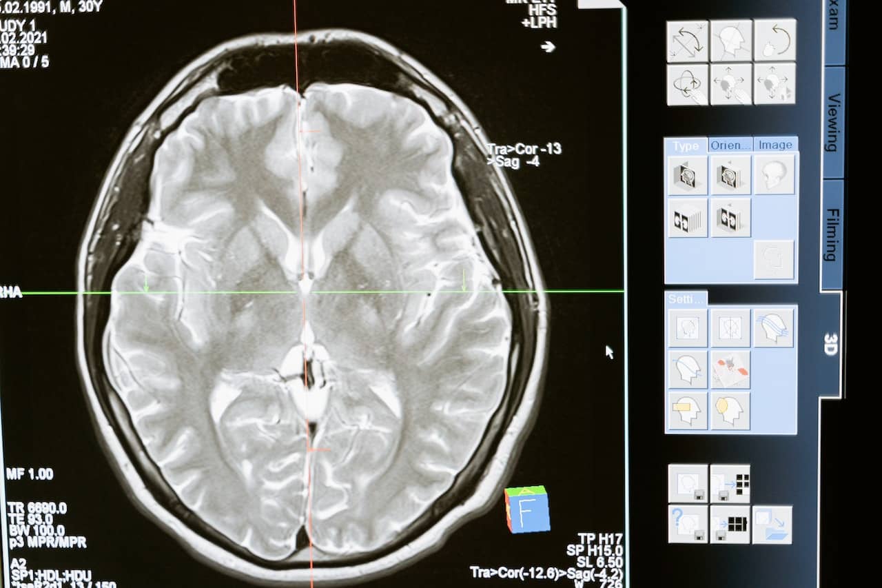 An x ray of a brain