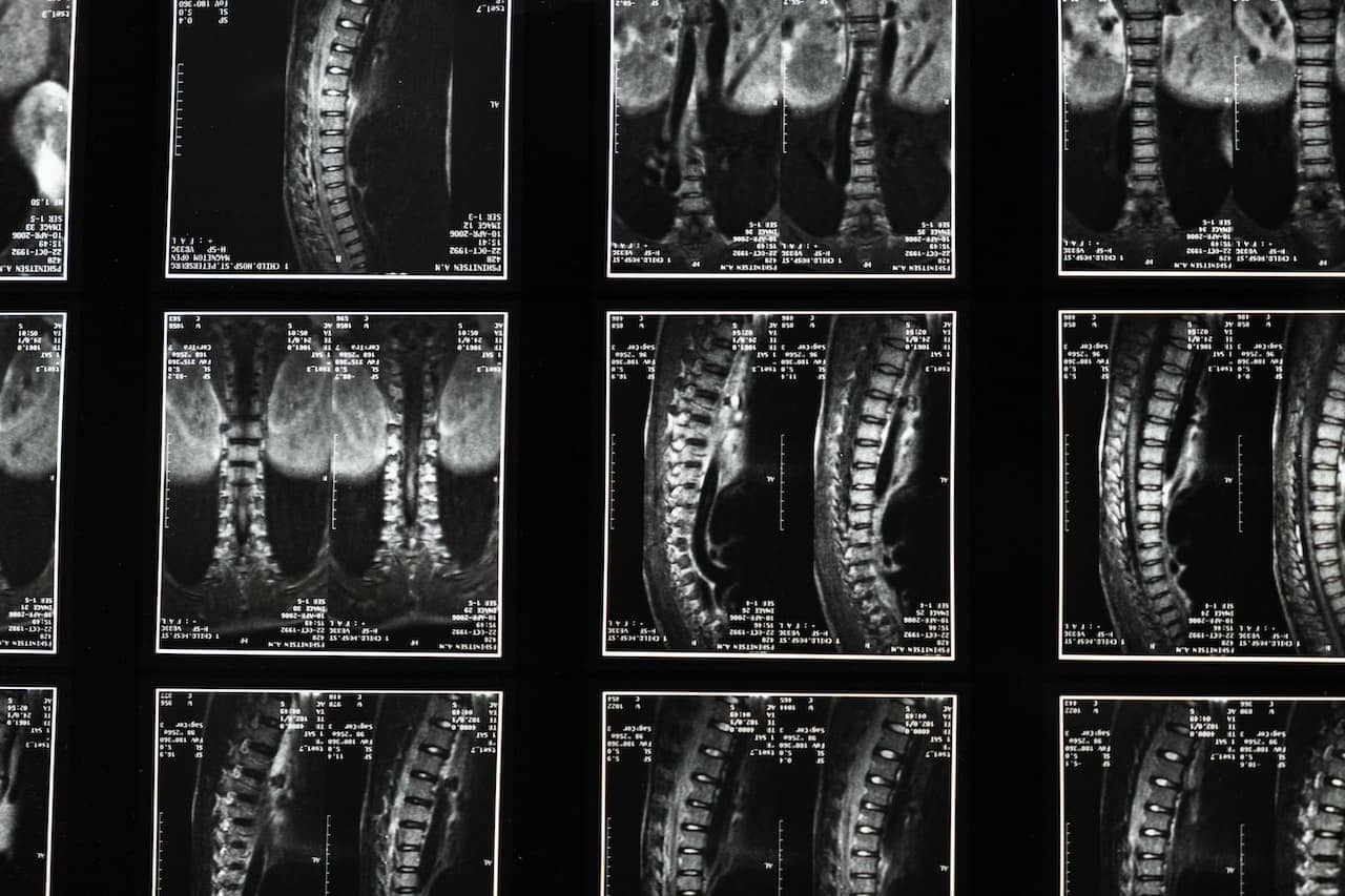 A collection of spine x rays