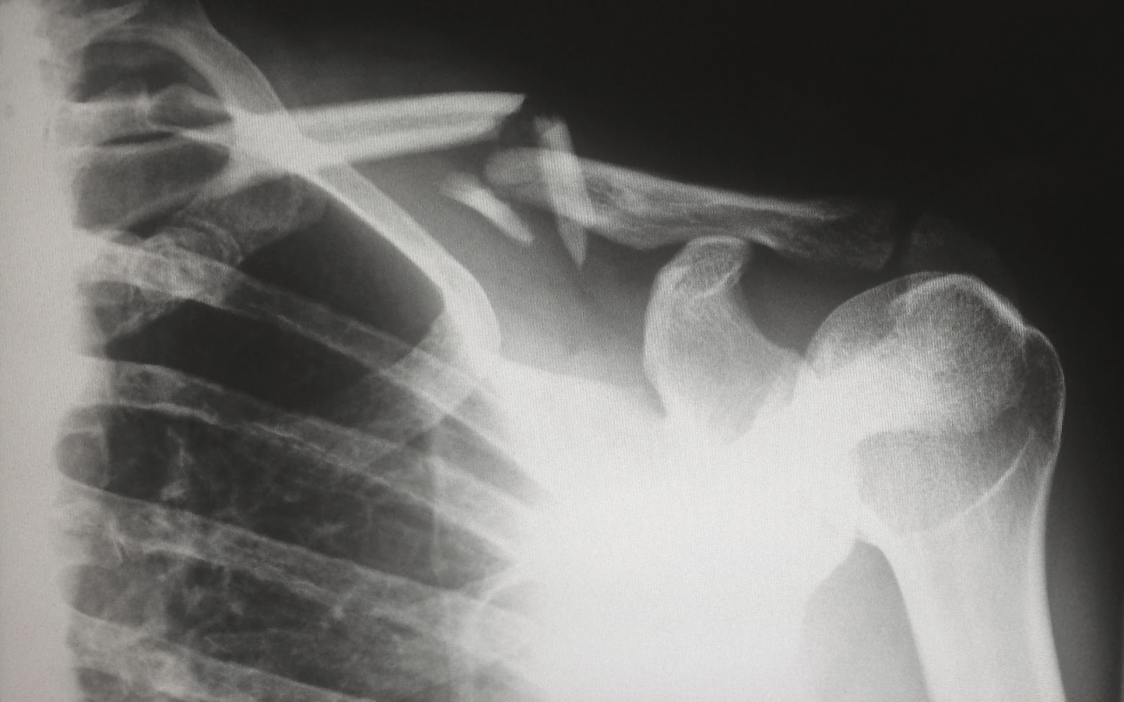 An x-ray of a broken collarbone
