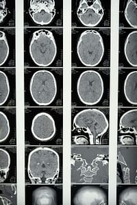 London Brain Injury