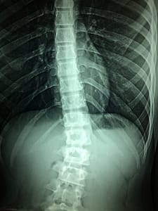 Spinal Cord injury