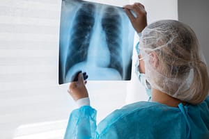 Lung Cancer Negligence