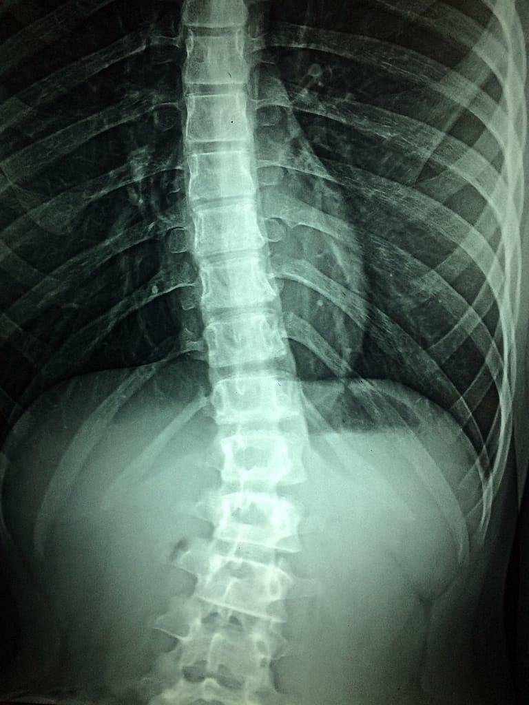 Spinal Cord injury