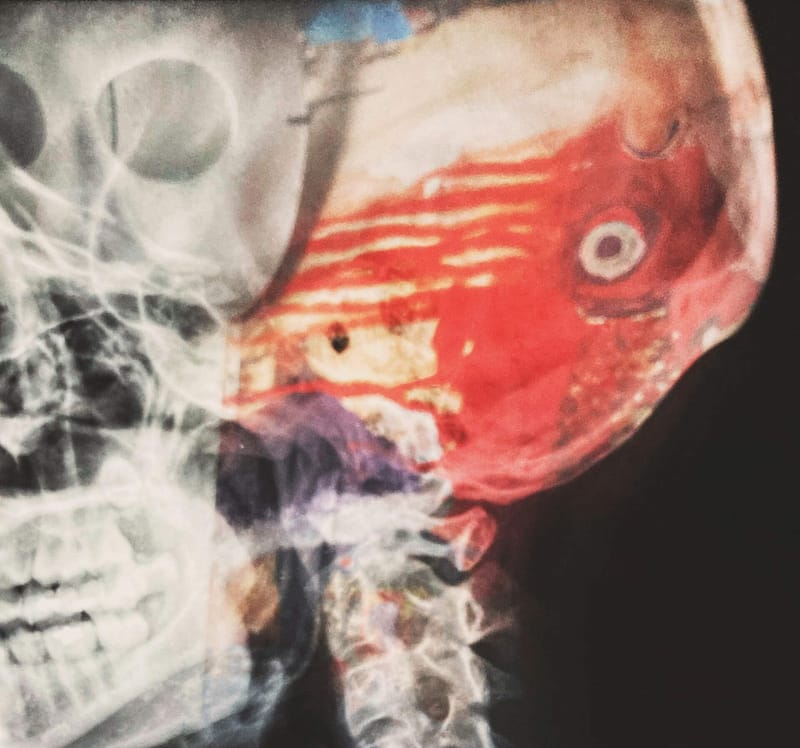 A bleeding skull on an x ray